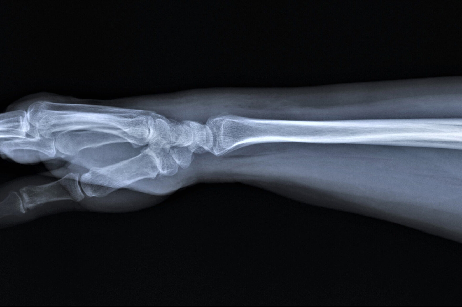 Dan Hooker X-Ray Reveals Stunning Comeback Was Made With Broken Arm