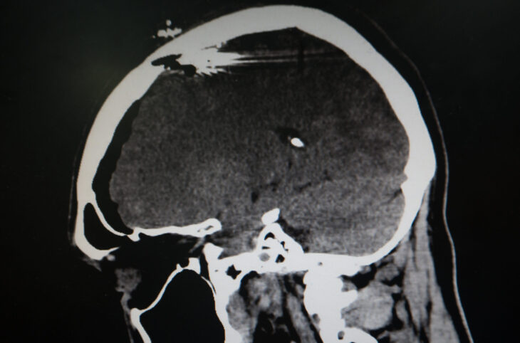 College Medical Student Parties 4 Days Not Knowing He Was Shot In Head